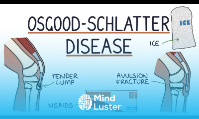 Understanding Osgood Schlatter Disease
