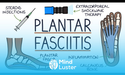 Understanding Plantar Fasciitis