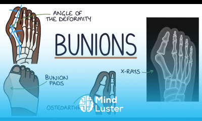 Understanding Bunions Hallux Valgus