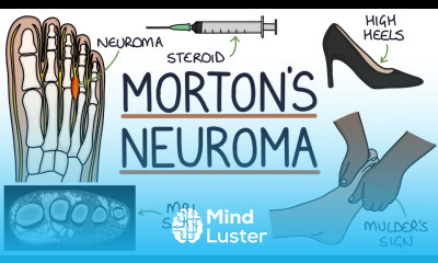 Morton s Neuroma