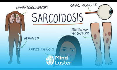 Understanding Sarcoidosis A Visual Guide for Students