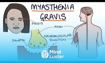 Myasthenia Gravis