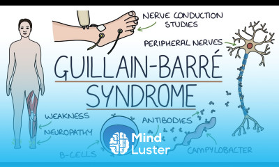 Understanding Guillain Barré Syndrome