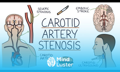 Understanding Carotid Artery Stenosis
