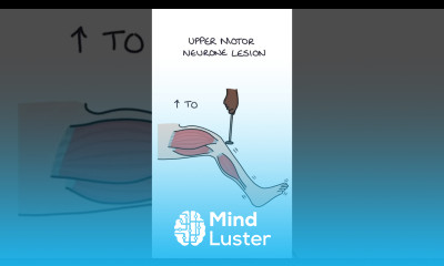 Upper Versus Lower Motor Neurone Lesions neurology medicine clinicalexamination