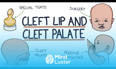 Cleft Lip and Cleft Palate For Students
