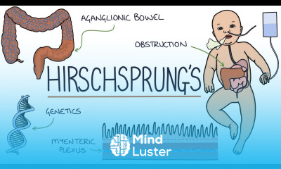 Hirschsprung s Disease