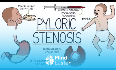 Understanding Pyloric Stenosis