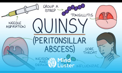 Understanding Quinsy Peritonsillar Abscess
