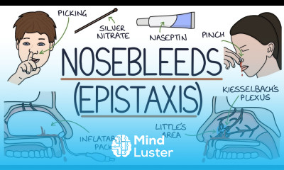 Understanding Nosebleeds Epistaxis