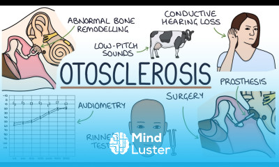 Understanding Otosclerosis