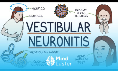 Understanding Vestibular Neuronitis
