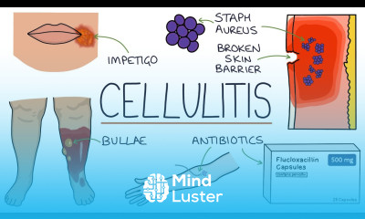 Understanding Cellulitis Skin and Soft Tissue Infections