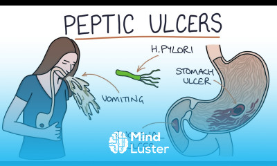 Understanding Stomach and Duodenal Ulcers