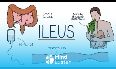 Understanding Ileus Paralytic Ileus