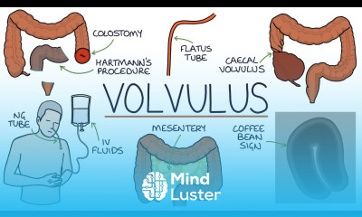 Understanding Volvulus Twisted Bowel