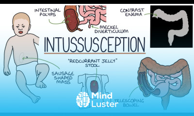 Understanding Intussusception
