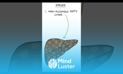 Stages of Non Alcoholic Fatty Liver Disease medicine gastroenterology