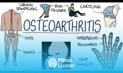 Understanding Osteoarthritis