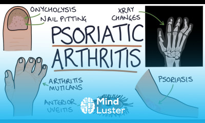 Psoriatic Arthritis