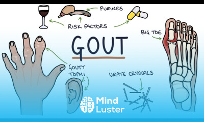 Gout Visual Explanation for Students