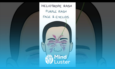 Dermatomyositis Skin Changes dermatology medicine rheumatology