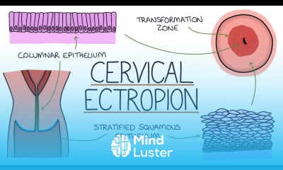 Learn Understanding Cervical Ectropion Cervical Erosion - Mind Luster