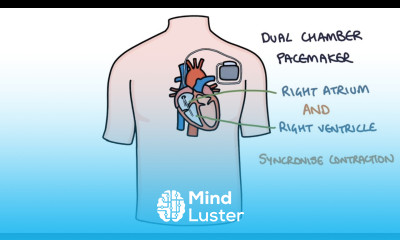 Understanding Pacemakers