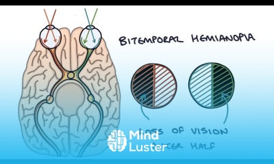 Understanding Bitemporal Hemianopia