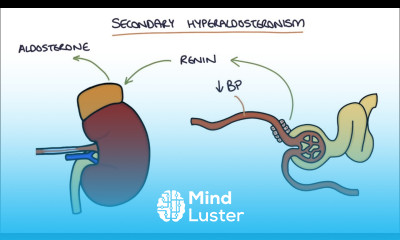 Hyperaldosteronism and Conn s Syndrome