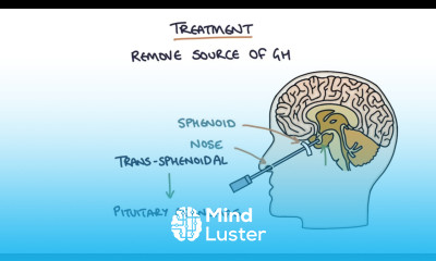 Understanding Acromegaly