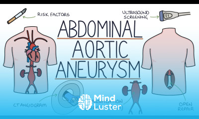 Understanding Abdominal Aortic Aneurysms