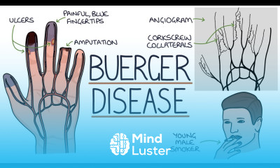 Understanding Buerger Disease Thromboangiitis Obliterans