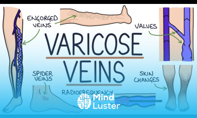 Understanding Varicose Veins