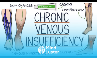 Understanding Chronic Venous Insufficiency