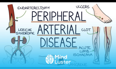 Understanding Peripheral Arterial Disease