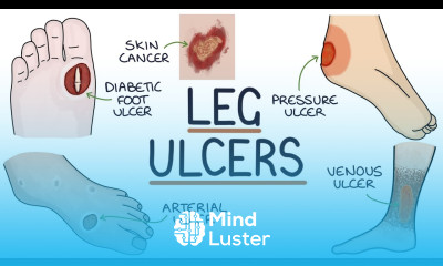 Understanding Leg and Foot Ulcers