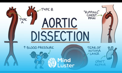 Understanding Aortic Dissection