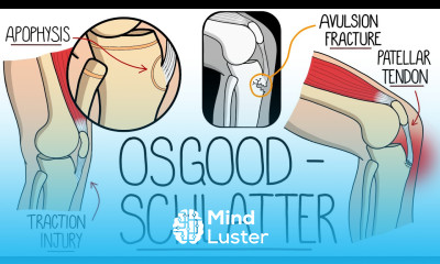 Osgood Schlatter Disease Made Easy Tibial Tubercle Apophysitis