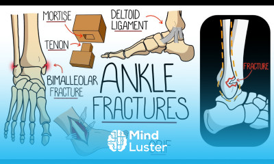 Ankle Fractures Made Easy