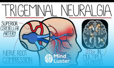 Understanding Trigeminal Neuralgia