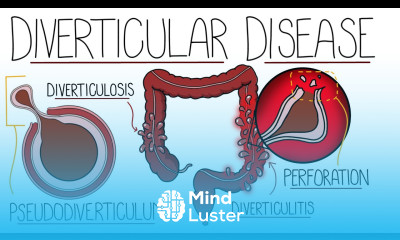 Understanding Diverticular Disease Diverticulosis vs Diverticulitis