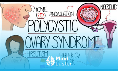 Polycystic Ovary Syndrome Made Easy PCOS Explained