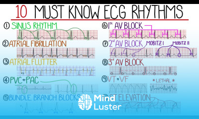 Most Common ECG Patterns You Should Know