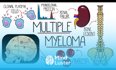 Understanding Multiple Myeloma Multiple Myeloma Explained Clearly