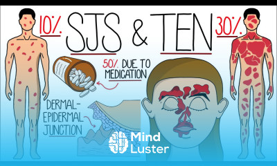 Understanding Stevens Johnson Syndrome and Toxic Epidermal Necrolysis SJS TEN