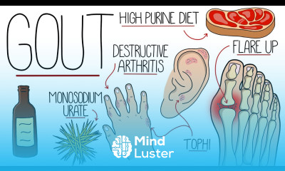 Understanding Gout Gout Explained Clearly