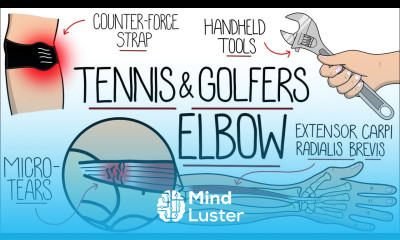 Understanding Tennis Elbow and Golfer s Elbow Lateral Medial Epicondylitis