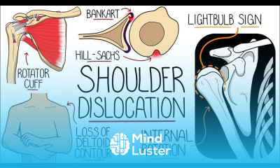Shoulder Dislocation Explained Clearly Glenohumeral Joint Dislocation