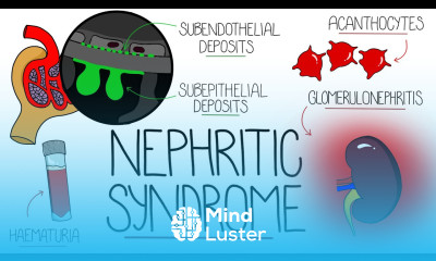 Understanding Nephritic Syndrome With Pathology Made Easy